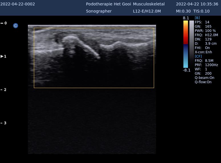 artrose grote teengewricht