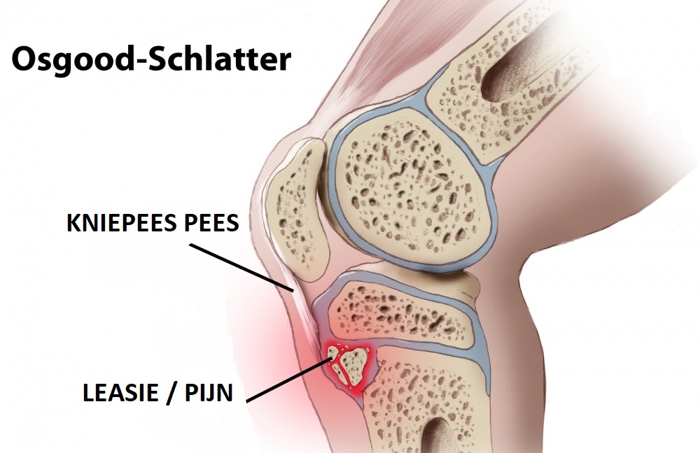 osgood schlatter