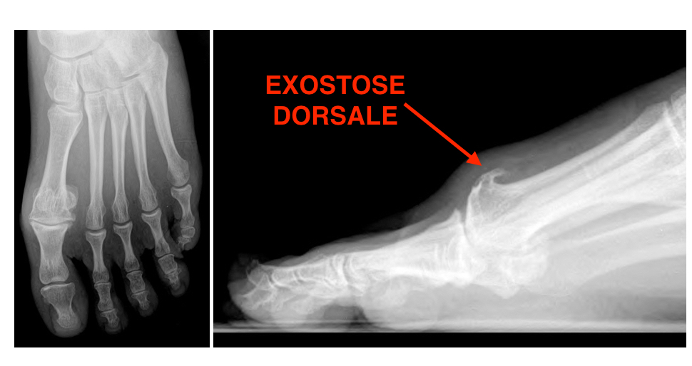 exostose voet