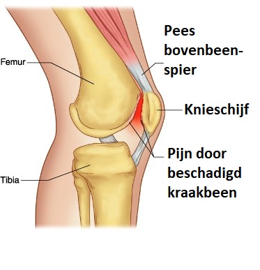 knie pijn