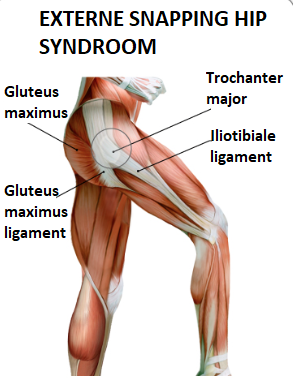 external snapping hip podotherapie het gooi