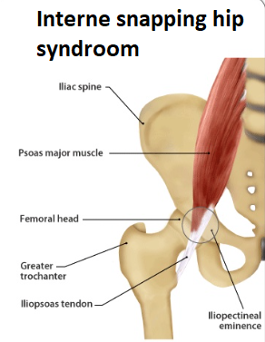 interne snapping hip podotherapie het gooi