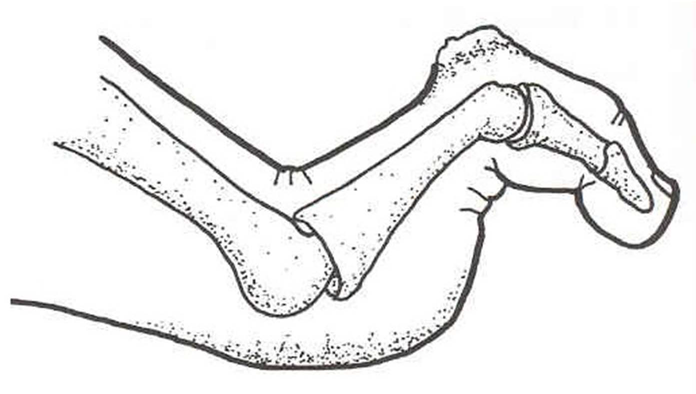 Hamerteen Podotherapie het Gooi 