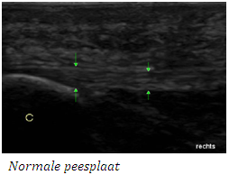 Podotherapie het Gooi normale peesplaat
