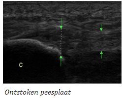 Podotherapie het Gooi ontstoken peesplaat