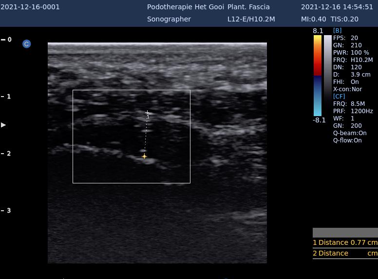 plantaire fascie echo