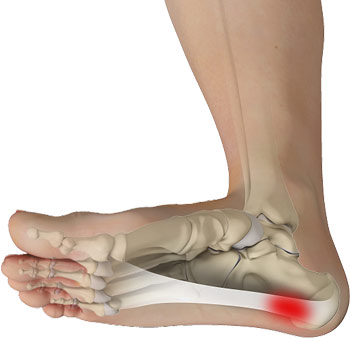 fasciitis plantaris
