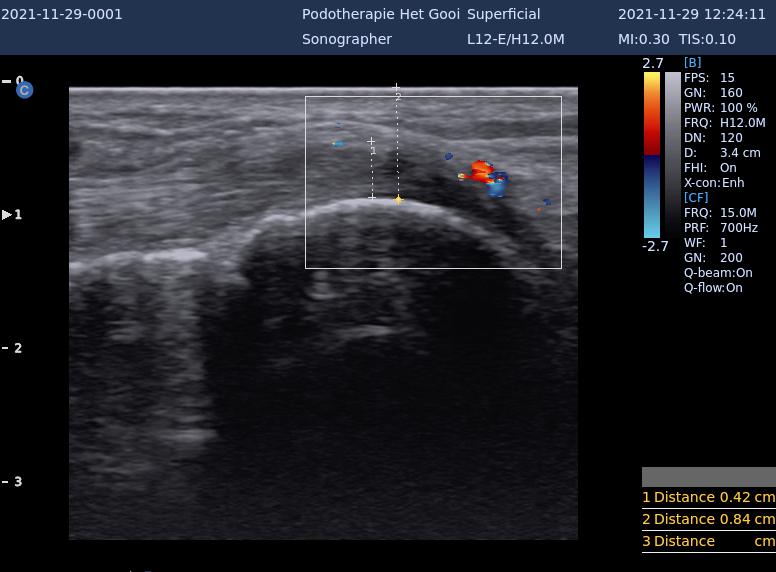 echo tibialis anterior